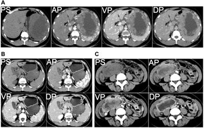 Rare c-KIT c.1926delA and c.1936T>G Mutations in Exon 13 Define Imatinib Resistance in Gastrointestinal Stromal Tumors and Melanoma Patients: Case Reports and Cell Experiments